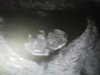 baby bilde ultralyd 8 + 1.jpg
