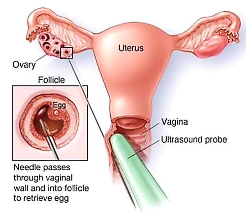 Uterus-.jpg