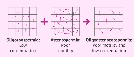 oligoasthenozoospermia.png